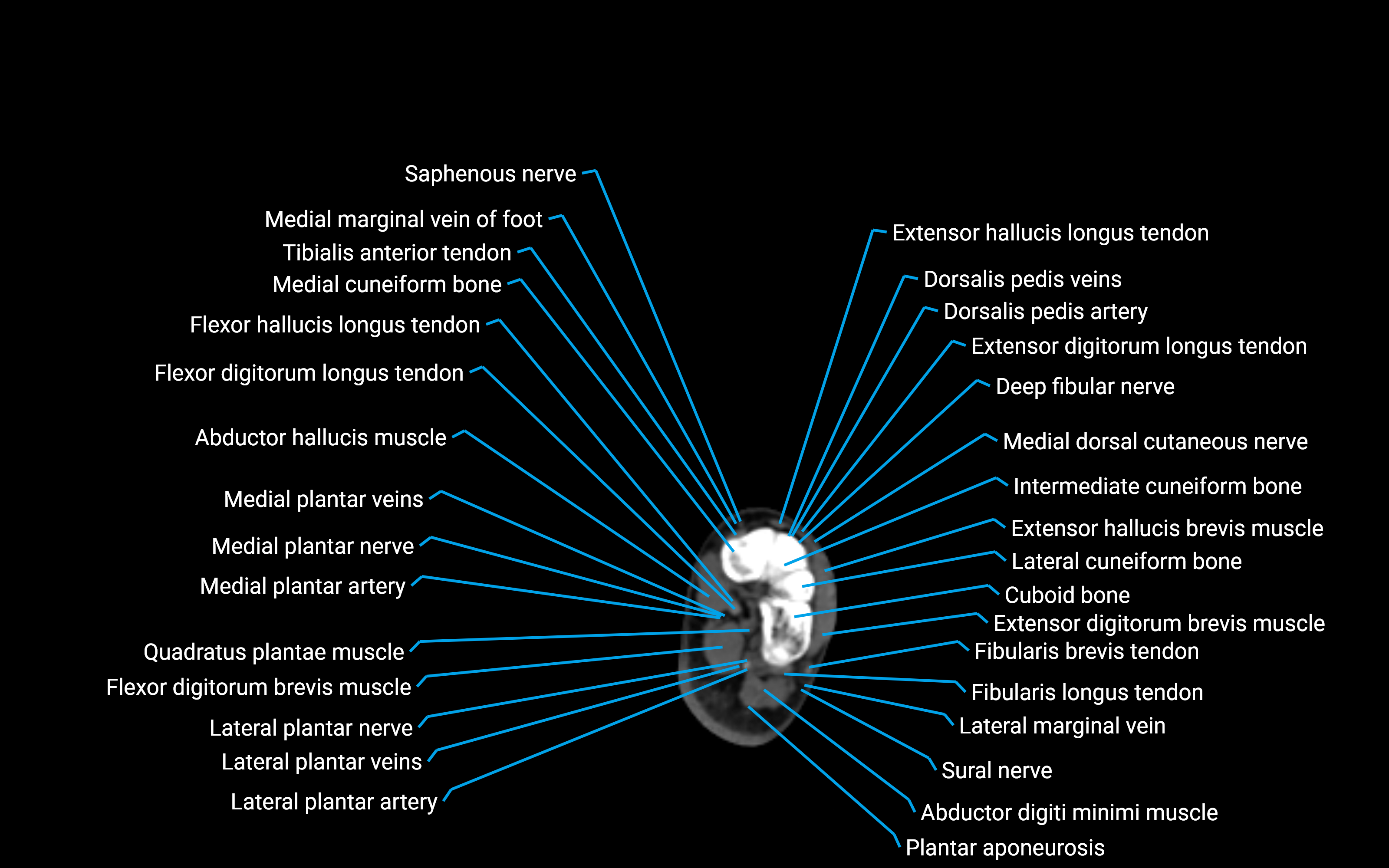 CT Lower leg axial cross sectional anatomy labelled image 178 (2).png